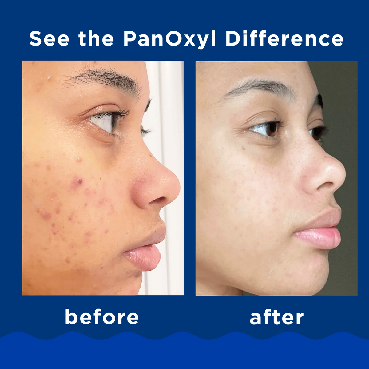 Acne Foaming Wash Maximum Strength 10% Benzoyl Peroxide