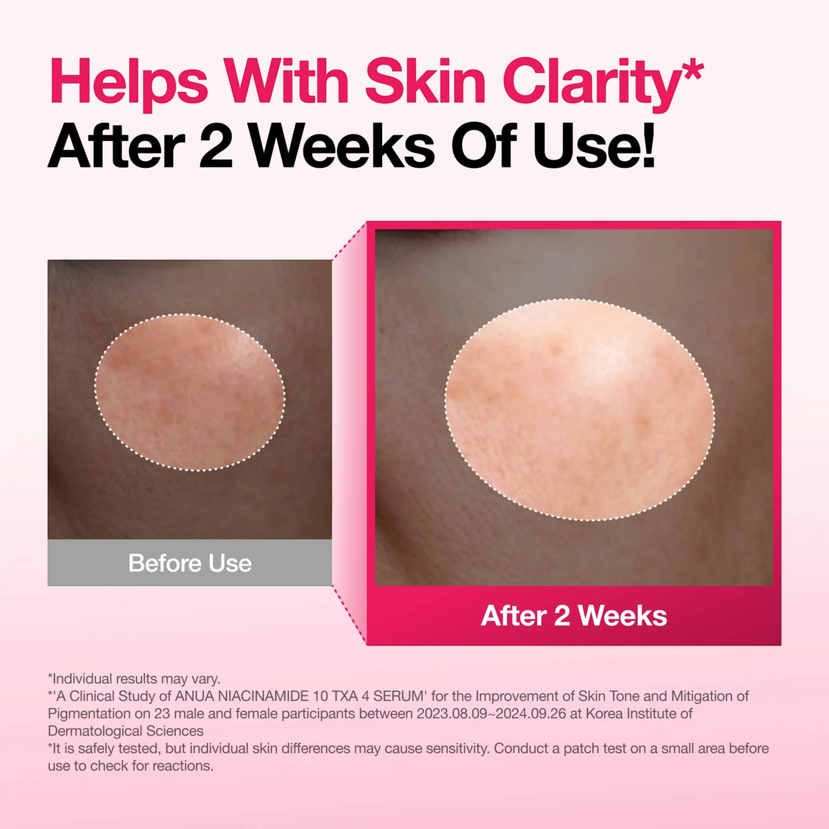 Anua Niacinamide 10 TXA 4 Serum 30 ml before and after infographic